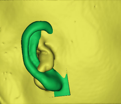 小耳畸形怎么辦？這有一份三維數(shù)字化治療方案請(qǐng)簽收！